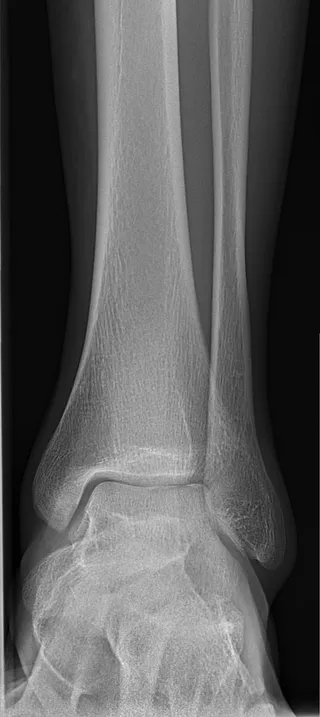 Illustrative X-ray of a normal ankle from the front, not one of Dr. Gadkari's patients.
