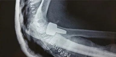 Side X-ray of the elbow after surgery showing a radial head implant.