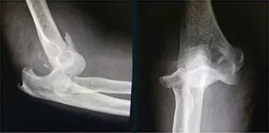 Side and front X-rays of an injured elbow before surgery.