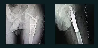 Two X-rays after corrective surgery showing a plate and screws fixing the hip.