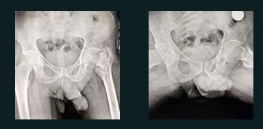 Two pelvis X-rays showing a hip fracture that has healed out of position.