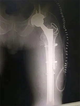 X-ray after revision surgery, showing a long-stem hip implant held with wires along the thigh bone.