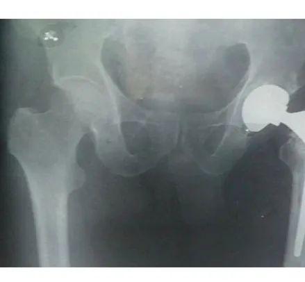 Pelvis X-ray showing an existing hip replacement on one side before revision surgery.