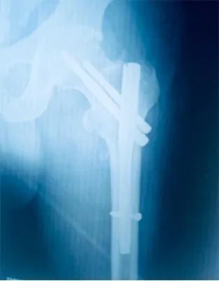 X-ray after surgery showing a metal nail and screws holding the hip fracture in place.