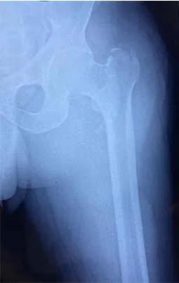 X-ray of the hip showing a fracture through the top of the thigh bone.