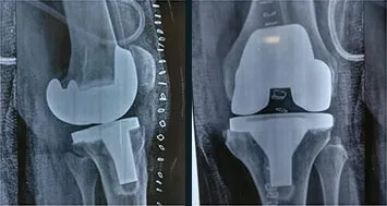 Side and front X-rays of a knee after total knee replacement, showing the metal and plastic implant.
