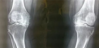 Standing X-ray of both knees before surgery, with the joint space narrowed by arthritis.