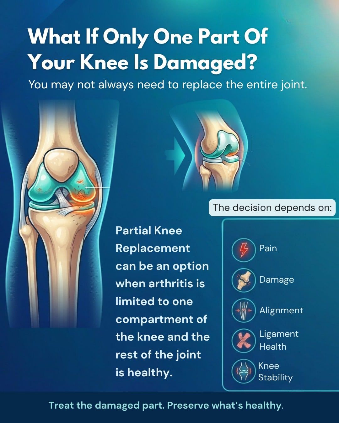 Graphic: What if only one part of your knee is damaged? A partial knee replacement can be an option when arthritis is limited to one compartment of the knee and the rest of the joint is healthy.