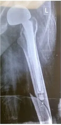 X-ray after surgery showing a long hip implant stem bridging the healed fracture.