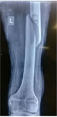 X-ray of the left thigh bone broken below the stem of an existing hip implant.