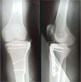 Front and side X-rays after surgery showing a plate and screws fixing the top of the shin bone.