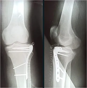 Front and side X-rays after surgery showing a plate and screws fixing the top of the shin bone.