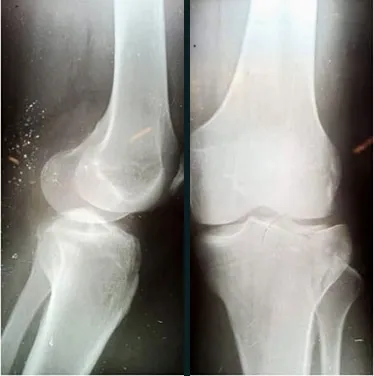 Side and front X-rays of the knee before surgery showing a fracture at the top of the shin bone.
