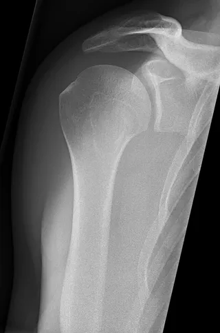 Illustrative X-ray of a normal shoulder joint, not one of Dr. Gadkari's patients.