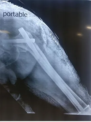 X-ray after surgery showing a long nail inside the thigh bone with a screw into the hip.