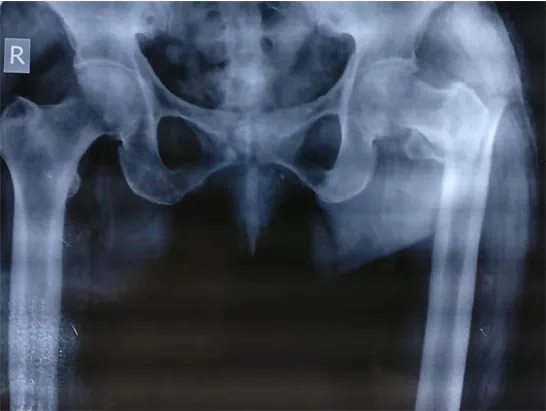 Pelvis X-ray showing a fracture of the upper thigh bone just below the hip.